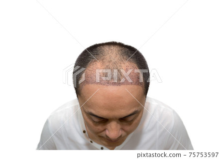 Close up top view of a man's head with hair transplant surgery with a receding hair line. Close up top view of a man's head with hair transplant surgery with a receding hair line. 75753597
