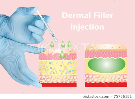 Cosmetic filler or dermal fillers 75756191
