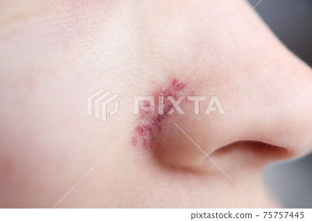 On wings of nose, skin after removal of vascular mesh On wings of nose, skin after removal of vascular mesh 75757445