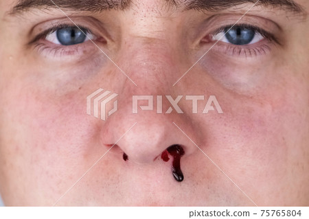 The man's nose started bleeding. High blood pressure caused blood vessels to rupture. A thin red trickle flows out of the sinuses. Consequences of vascular problems and severe stress 75765804