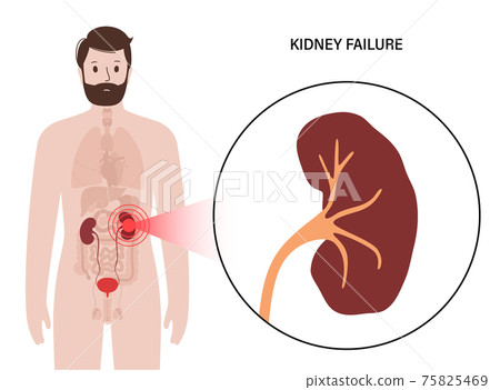 Kidney disease concept 75825469