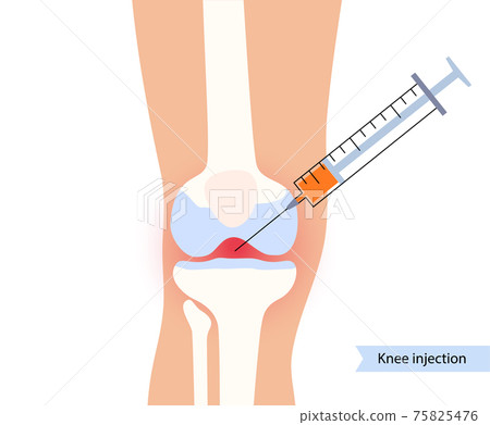 Knee Injection concept 75825476