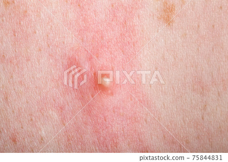 ripe pimple on the inflamed reddened skin of a person close-up, problem dry skin with an inflammatory rash. 75844831