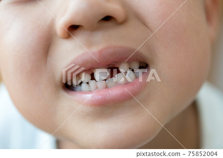 Regeneration of milk teeth 75852004