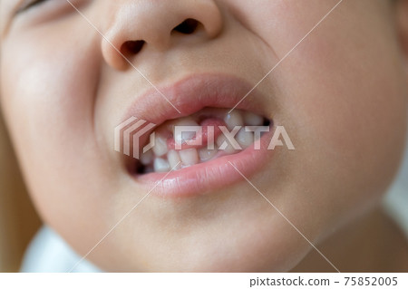 Regeneration of milk teeth 75852005