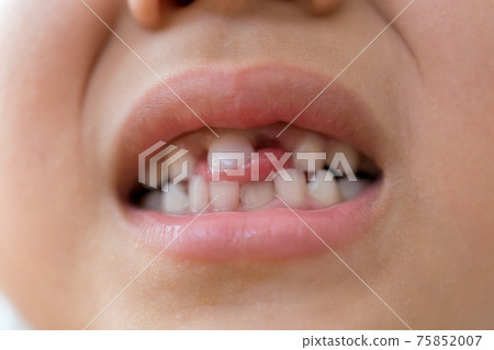 Regeneration of milk teeth 75852007