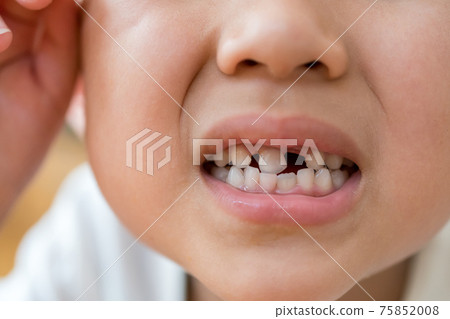 Regeneration of milk teeth Regeneration of milk teeth 75852008