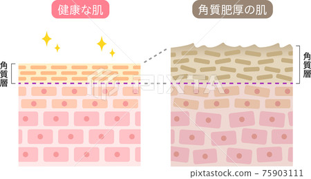 Hyperkeratosis healthy skin cross section 75903111