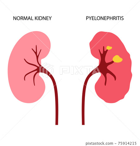 Kidney disease concept 75914215