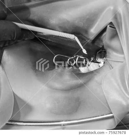 A patient at a dentist's appointment, a doctor uses a rubber dam to treat teeth, disinfects a tooth for filling. A patient at a dentist's appointment, a doctor uses a rubber dam to treat teeth, disinfects a tooth for filling. 75927678