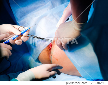 Surgeons' hands in sterile gloves hold medical instruments. Surgeons' hands in sterile gloves hold medical instruments. 75930296