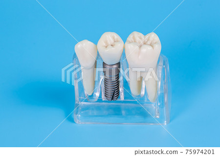 Dental crowns, imitation of a dental prosthesis of a dental bridge with implant 75974201