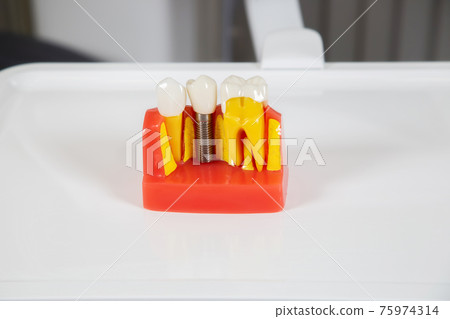 Plastic dental crowns, imitation of a dental prosthesis of a dental bridge 75974314