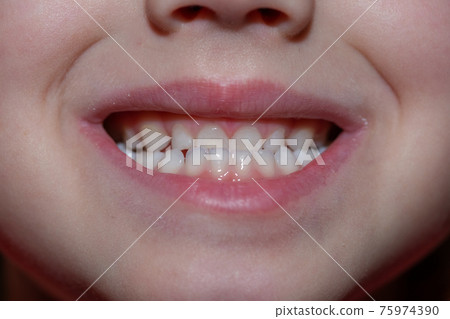 Malocclusion of a child, close-up on the front teeth of a child 75974390