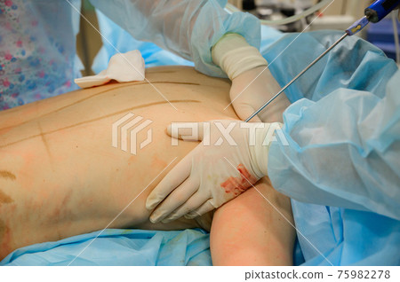 Plastic surgery to reduce body volume. The process of liposuction of the back of a woman. Pumping out subcutaneous fat in the operating room. 75982278