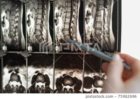 Doctor points out a hernia on magnetic resonance imaging of the lumbar spine Doctor points out a hernia on magnetic resonance imaging of the lumbar spine 75982696