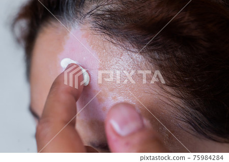 Vitiligo. A close-up portrait of a woman with no skin pigmentation on her forehead. Girl smears sunscreen on a white spot on the skin of the face. Autoimmune disease. Vitiligo. A close-up portrait of a woman with no skin pigmentation on her forehead. Girl smears sunscreen on a white spot on the skin of the face. Autoimmune disease. 75984284