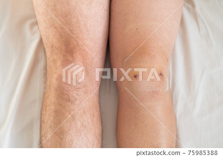 Close-up of a surgical suture after laparoscopic minisk surgery. A man with one knee operated on Close-up of a surgical suture after laparoscopic minisk surgery. A man with one knee operated on 75985388