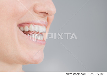 Close-up portrait of a woman with a plastic transparent retainer. A girl corrects a bite with the help of an orthodontic device. Copy space 75985486