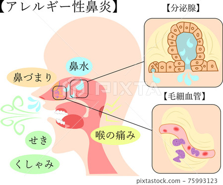 過敏性鼻炎插畫解說 75993123