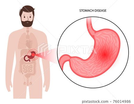 Stomach disease concept 76014986