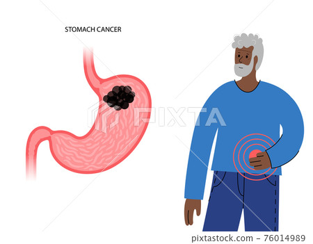 Stomach cancer concept 76014989