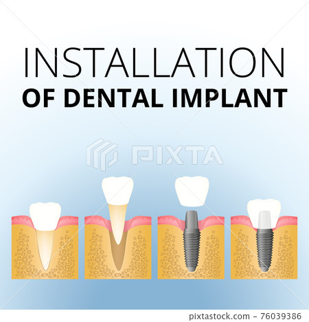 implantation of the tooth 76039386