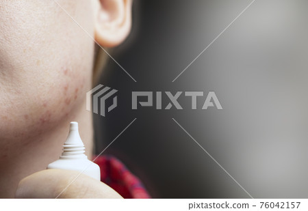 Acne on the chin: demodecosis tick on the skin of a girl's face. Patient at the appointment of a dermatologist. Problem skin and beauty concept. Acne on the chin: demodecosis tick on the skin of a girl's face. Patient at the appointment of a dermatologist. Problem skin and beauty concept. 76042157