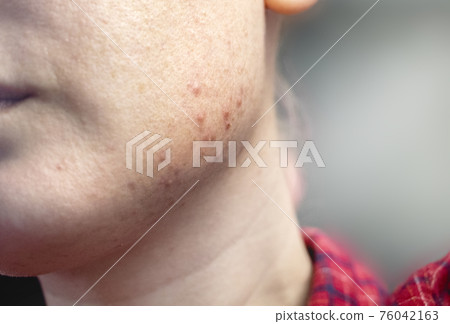Acne on the chin: demodecosis tick on the skin of a girl's face. Patient at the appointment of a dermatologist. Problem skin and beauty concept. 76042163