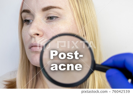 Post-acne under a magnifying glass. Skin with acne scars. Woman at the appointment with a dermatologist Post-acne under a magnifying glass. Skin with acne scars. Woman at the appointment with a dermatologist 76042539