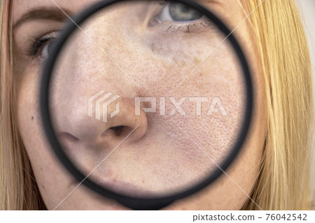 Expanded pores, black spots, acne, rosacea close-up on the nose. A woman is being examined by a doctor. Dermatologist examines the skin through a magnifier, a magnifying glass 76042542