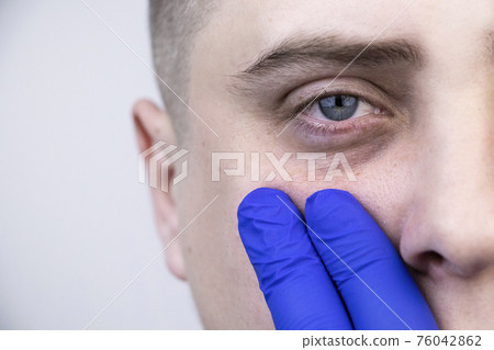 Bags under the eyes, hernias on the face of a man. Plastic surgeon examines a patient before blepharoplasty Bags under the eyes, hernias on the face of a man. Plastic surgeon examines a patient before blepharoplasty 76042862