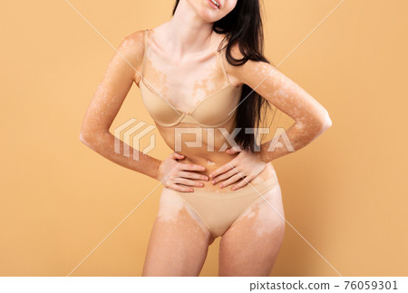 Love My Body. Closeup Shot Of Young Woman With Vitiligo Skin Love My Body. Closeup Shot Of Young Woman With Vitiligo Skin 76059301