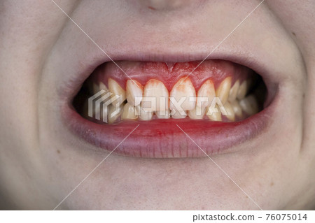 Gum bleeding and inflammation close up. A man examined by a dentist. The diagnosis of gingivitis 76075014