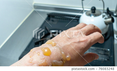 Hand burns, blisters, when a man stands in the kitchen, burns increase due to corona burns Hand burns, blisters, when a man stands in the kitchen, burns increase due to corona burns 76083248