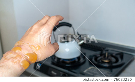 手燒傷，水泡，當一個人站在廚房裡時，由於電暈燒傷，燒傷增加 76083250
