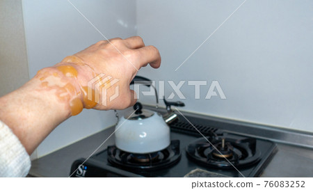 Hand burns, blisters, when a man stands in the kitchen, burns increase due to corona burns 76083252