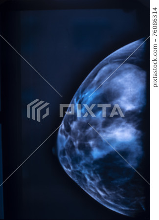 Breast mamogram xray test Breast mamogram xray test 76086314