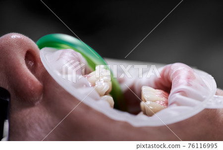 Top view on opened mouth with ceramic braces on white upper teeth Top view on opened mouth with ceramic braces on white upper teeth 76116995