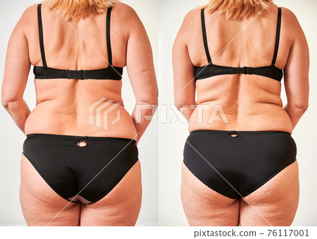 Woman's body before and after weight loss Woman's body before and after weight loss 76117001