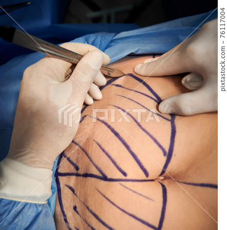 Surgeon hands performing plastic surgery in clinic. Surgeon hands performing plastic surgery in clinic. 76117004