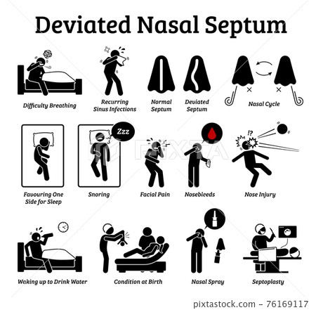 Deviated nasal septum icons. Illustrations depict signs and symptoms of nose problem. Difficulty breathing, sinus infection, snoring, and facial pain. Treatments are nasal spray and septoplasty. Deviated nasal septum icons. Illustrations depict signs and symptoms of nose problem. Difficulty breathing, sinus infection, snoring, and facial pain. Treatments are nasal spray and septoplasty. 76169117