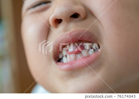 younger, teeth, person 76174843