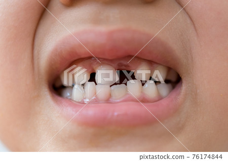 younger, teeth, baby boy 76174844