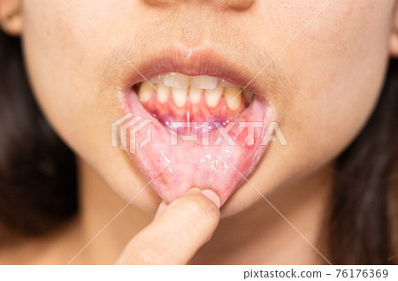 Asian woman have Aphthous ulcer or Canker sore on mouth at lip Asian woman have Aphthous ulcer or Canker sore on mouth at lip 76176369