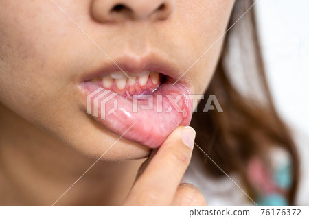 Asian woman have Aphthous ulcer or Canker sore on mouth at lip 76176372