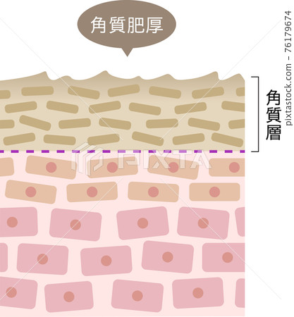 角化過度橫斷面 76179674