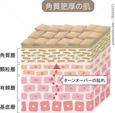 Hyperkeratosis Cross Section Three-dimensional - Stock Illustration 