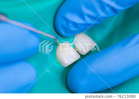 Dentistry, patient teeth close-up on a protective latex napkin. Dentist in blue gloves treats teeth Dentistry, patient teeth close-up on a protective latex napkin. Dentist in blue gloves treats teeth 76213090