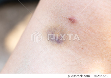 Closed up background of violet lesion on asian woman skin Closed up background of violet lesion on asian woman skin 76244839